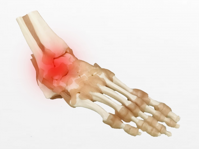 腓骨筋腱脱臼は保存療法とサポーターで対処 手術はどんな時に必要 白石市で整体なら白石接骨院いとうへ ３万人以上を施術し紹介率95