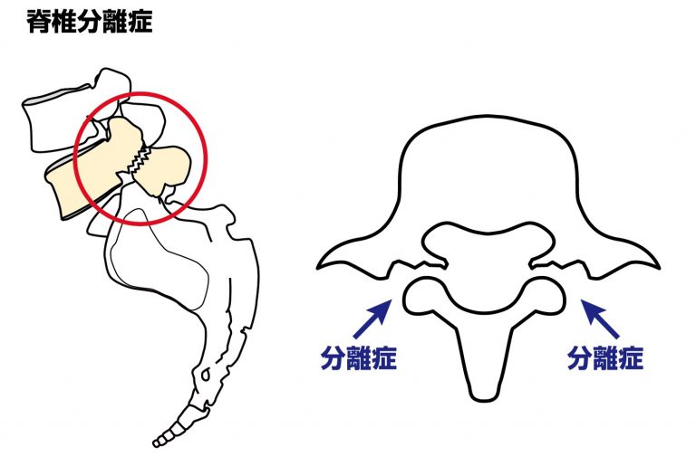 腰椎分離症の症状や治療法、リハビリと予防法を詳しく解説！ 白石市で整体なら白石接骨院いとうへ！3万人以上を施術し