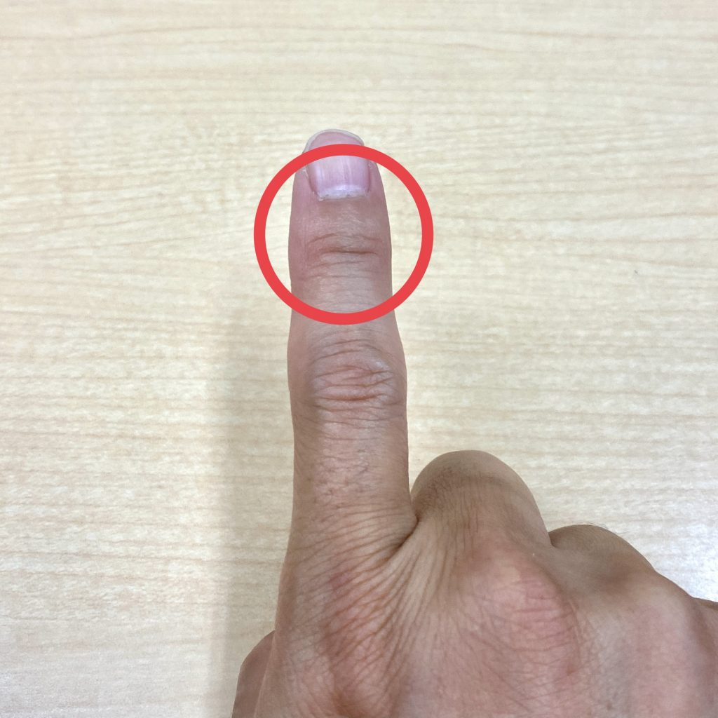 マレットフィンガーの症状とは？原因と治療法、よくある疑問にお答えします