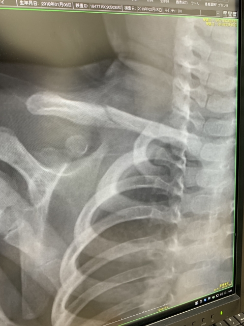 鎖骨骨折の後遺症とは 治療法や全治期間 よくある疑問にお答えします 白石市で整体なら白石接骨院いとうへ ３万人以上を施術し紹介率95