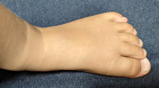 足の甲が腱鞘炎になる原因とは 症状やセルフでできる対処法を解説します 白石市で整体なら白石接骨院いとうへ ３万人以上を施術し紹介率95
