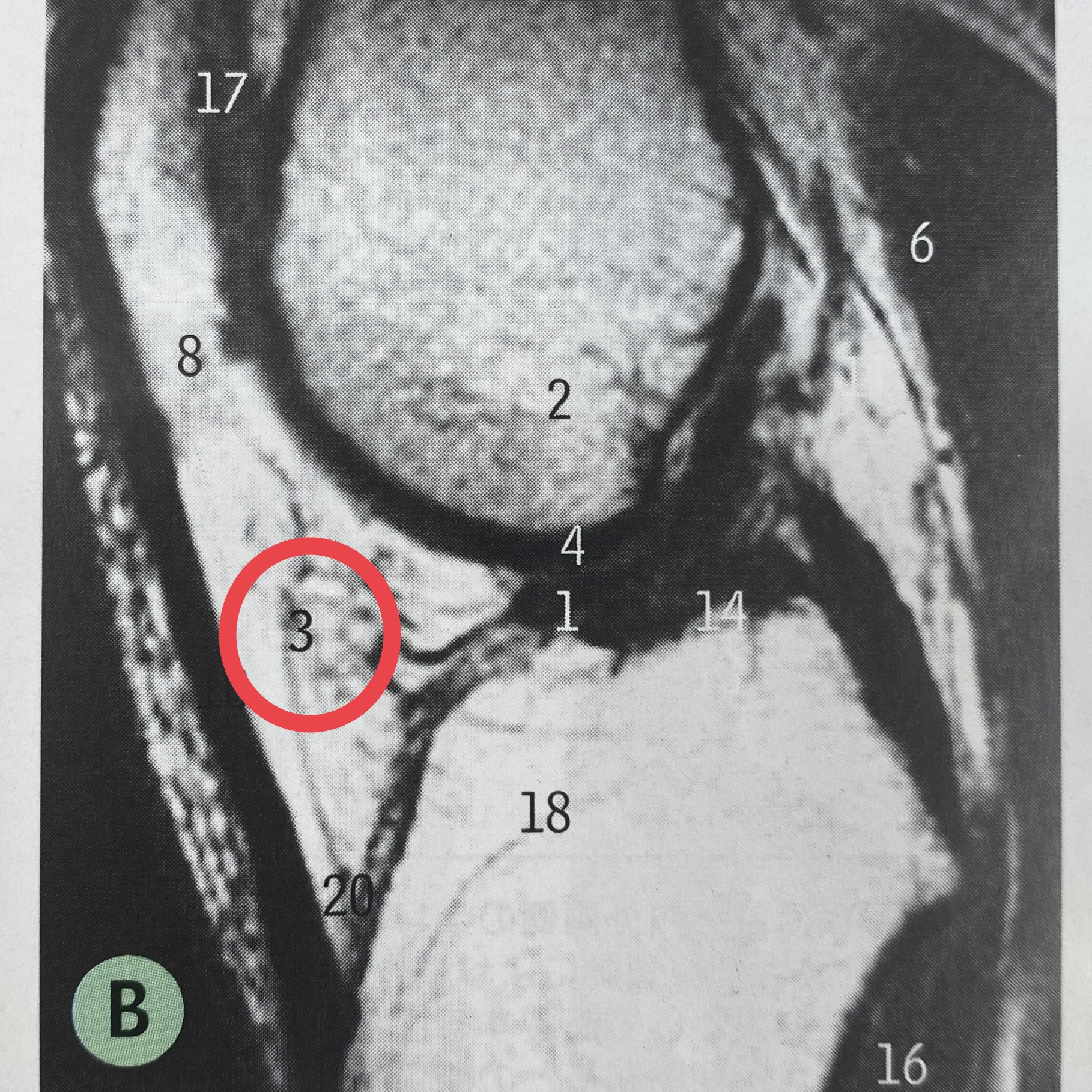 膝蓋下脂肪体炎とは？原因や症状、効果的なストレッチと疑問にお伝えします