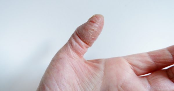 「親指の付け根が痛い」について。症状や原因、なりやすい動作とは？　