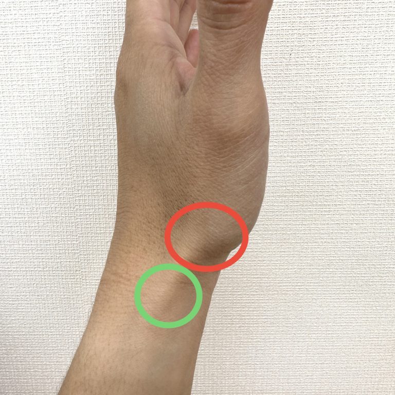 親指付け根痛み腫れ, 足の親指の付け根が腫れている _ 「母指CM関節症」 – ITET